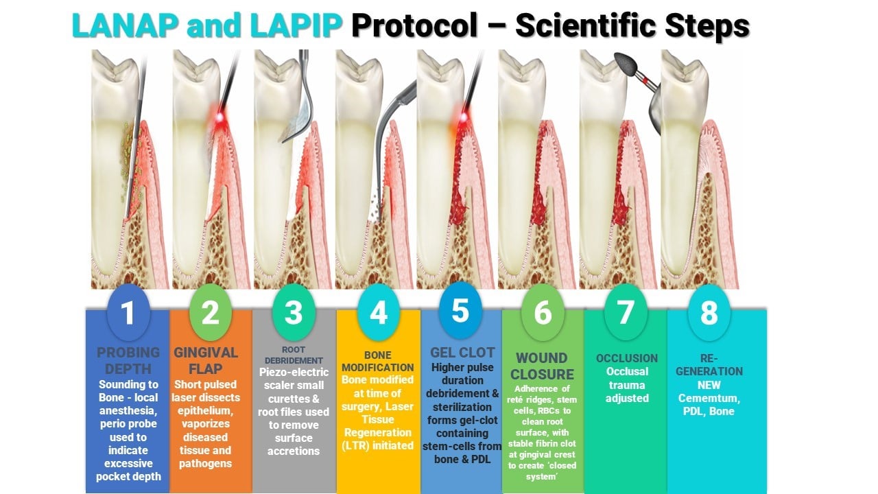 LANAP Steps